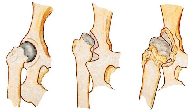 Hip dysplasia is a secondary cause of coxarthrosis
