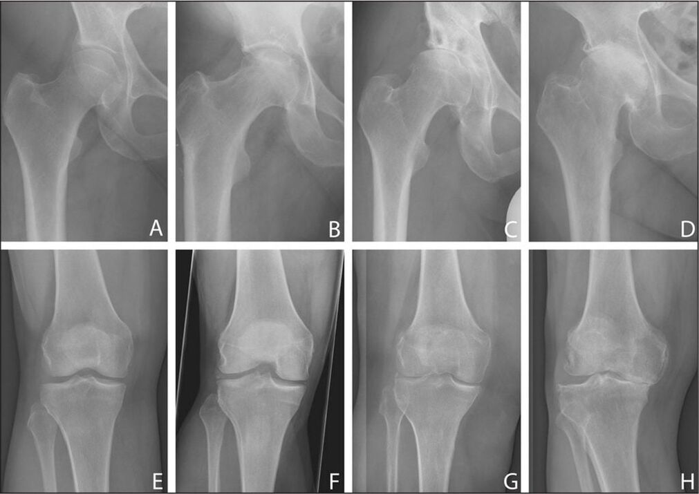 Hip joint arthrosis in dynamics
