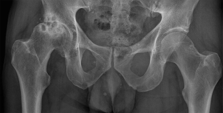 Stage 3 hip joint arthrosis on x-ray