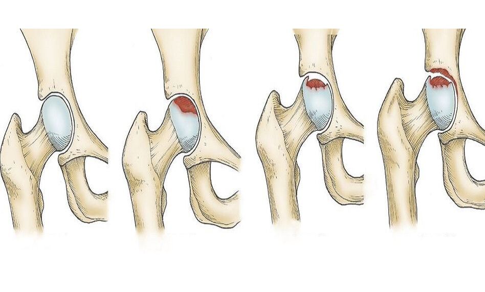 development of hip pain