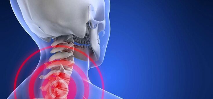 Osteochondrosis of the cervical area