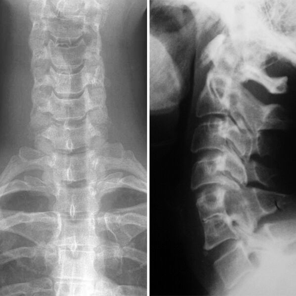 X -ray cervical spine