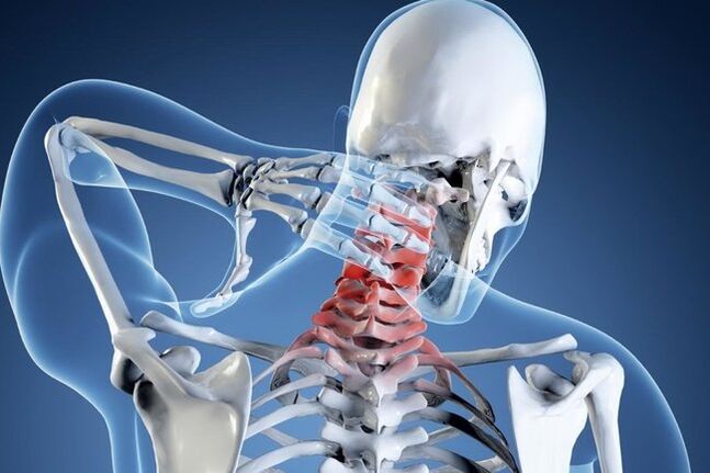 Osteochondrosis of the cervical area
