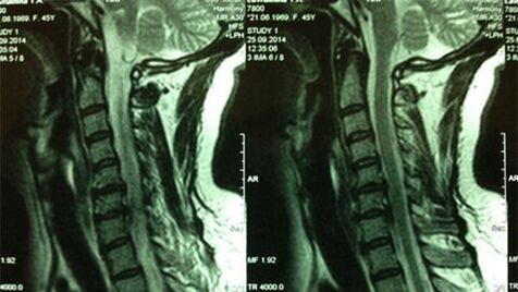 MRI from the cervical department