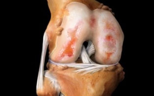 is knee arthrosis