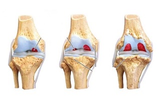 stage of arthrosis of the knee joint