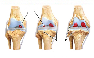 stage of knee arthrosis