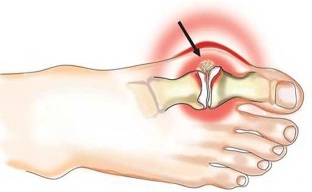 Inflammation of the joints between the thumb and foot in arthritis