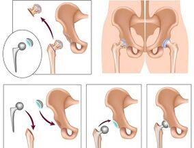 arthroplasty for arthrosis of the hip joint