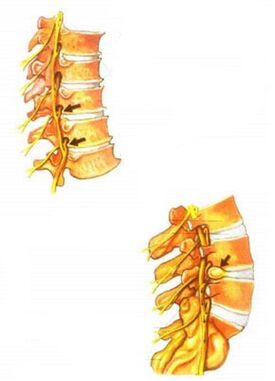 picture of spinal osteochondrosis