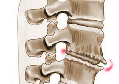 damage to the vertebrae with thoracic osteochondrosis